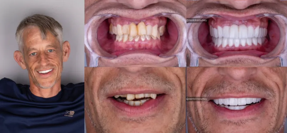 Gray showing his new Hollywood Smile in Turkey